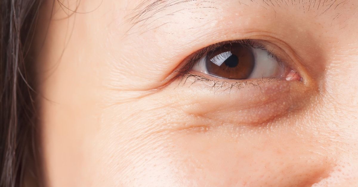 Best Ways for Removing Dark Circles under the Eyes